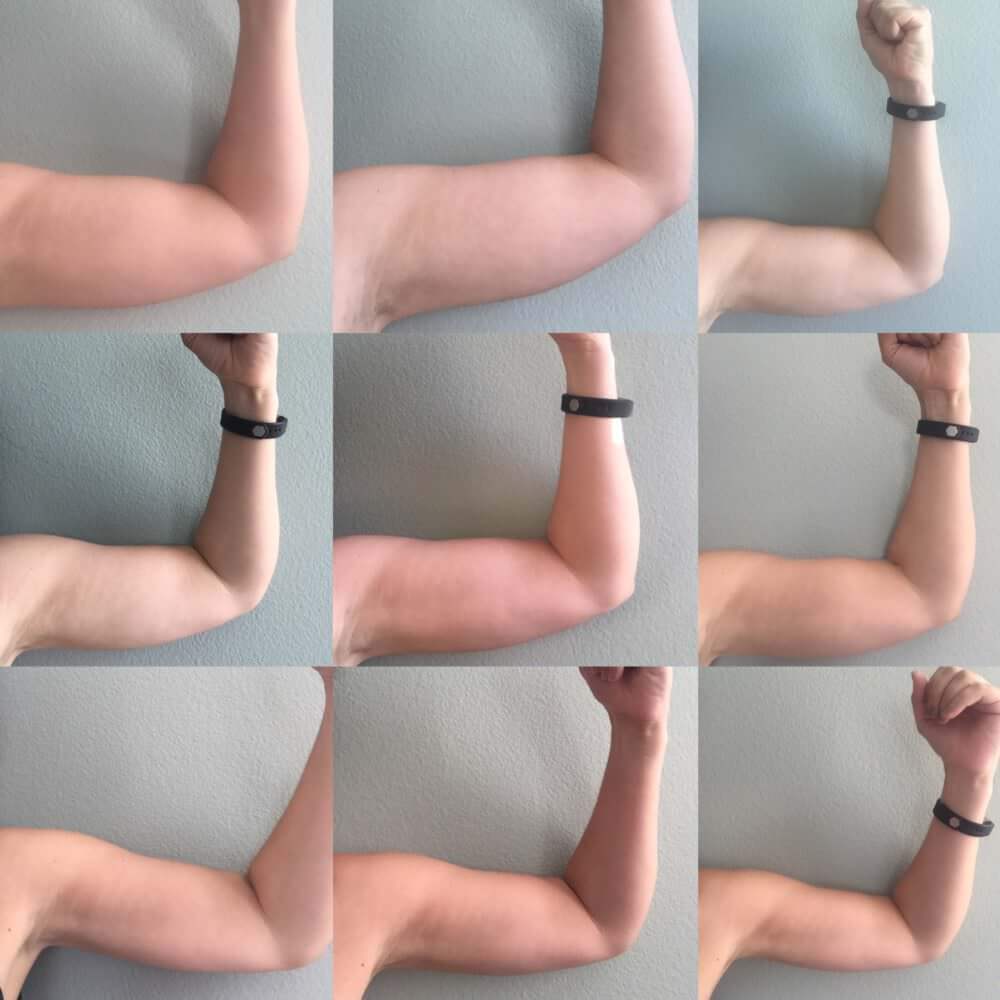 Arm Flab Before And After